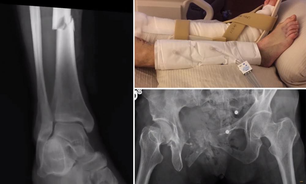 On the left and bottom, X-ray images show the broken leg and pelvis that Joyce Johnson suffered after being thrown from a bike trolley in 2015. On the top, a photo shows Joyce’s legs as she heeled at VCU Medical Center. Photos courtesy of the Johnsons