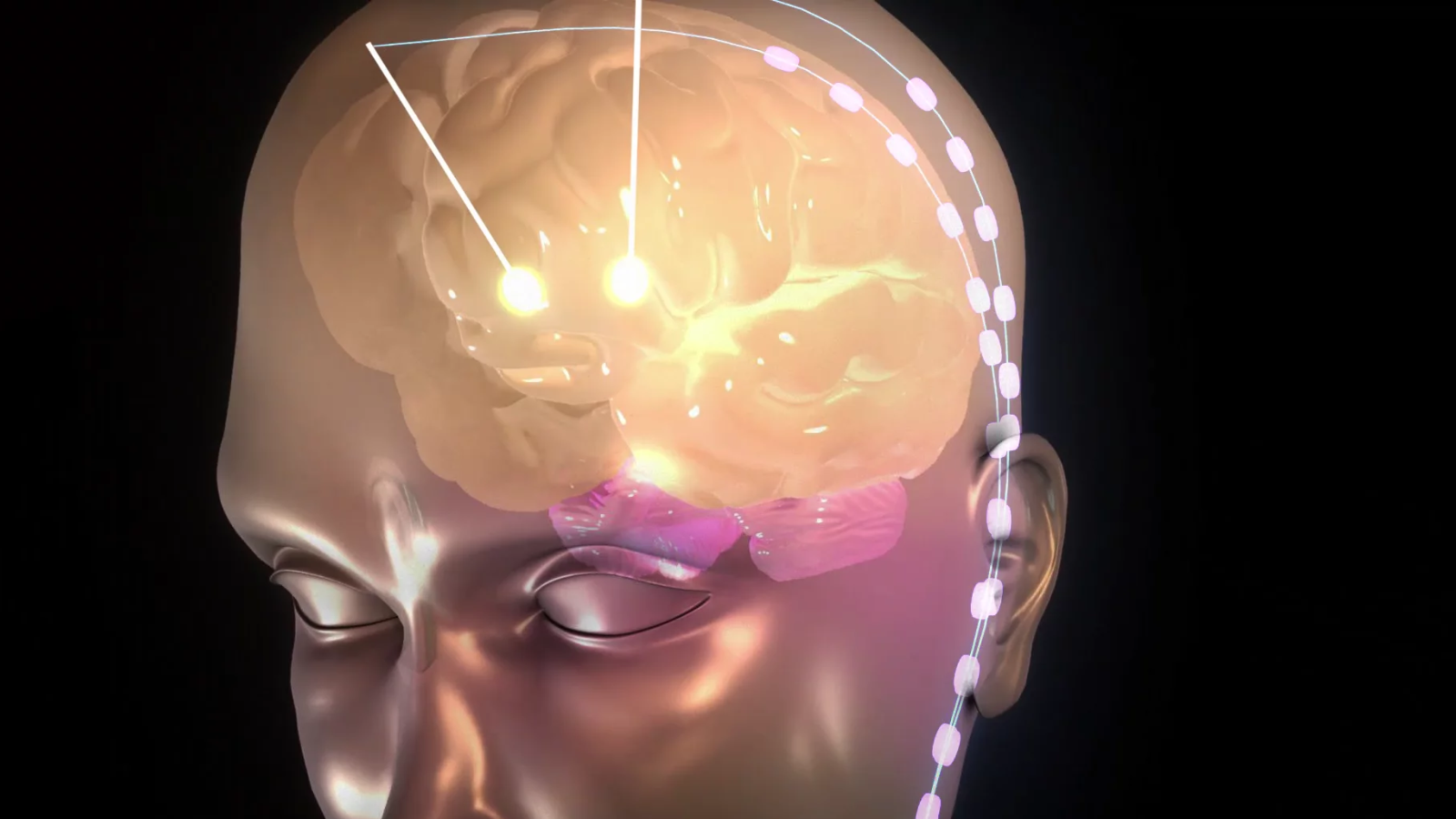 Deep Brain Stimulation